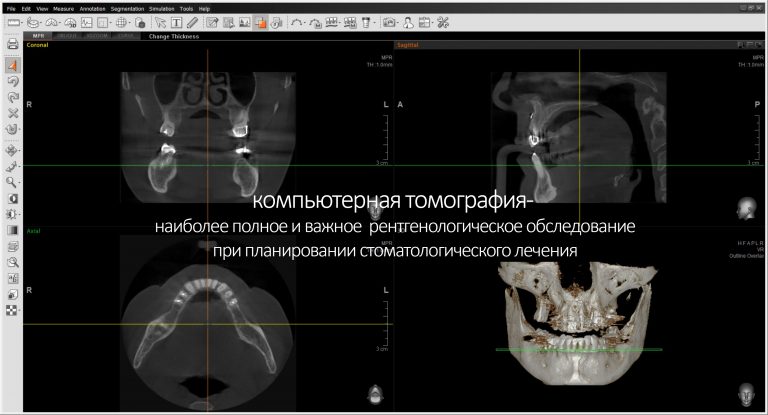 Проведение компьютерной томографии необходимо пациентам с вич инфекцией и иммуносупрессией