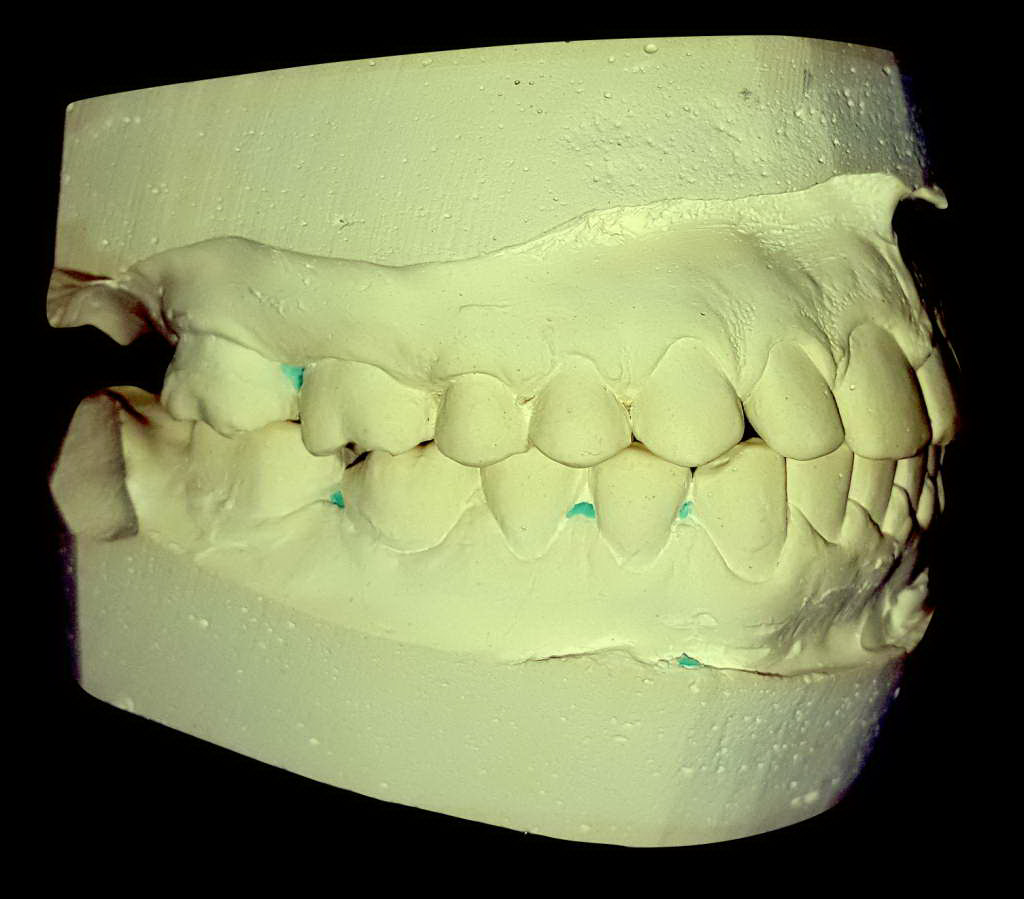 Изготовление гипсовой модели. Гипсовая модель зубов. Гипсовые модели челюстей. Диагностические гипсовые модели. Диагностические модели челюстей.