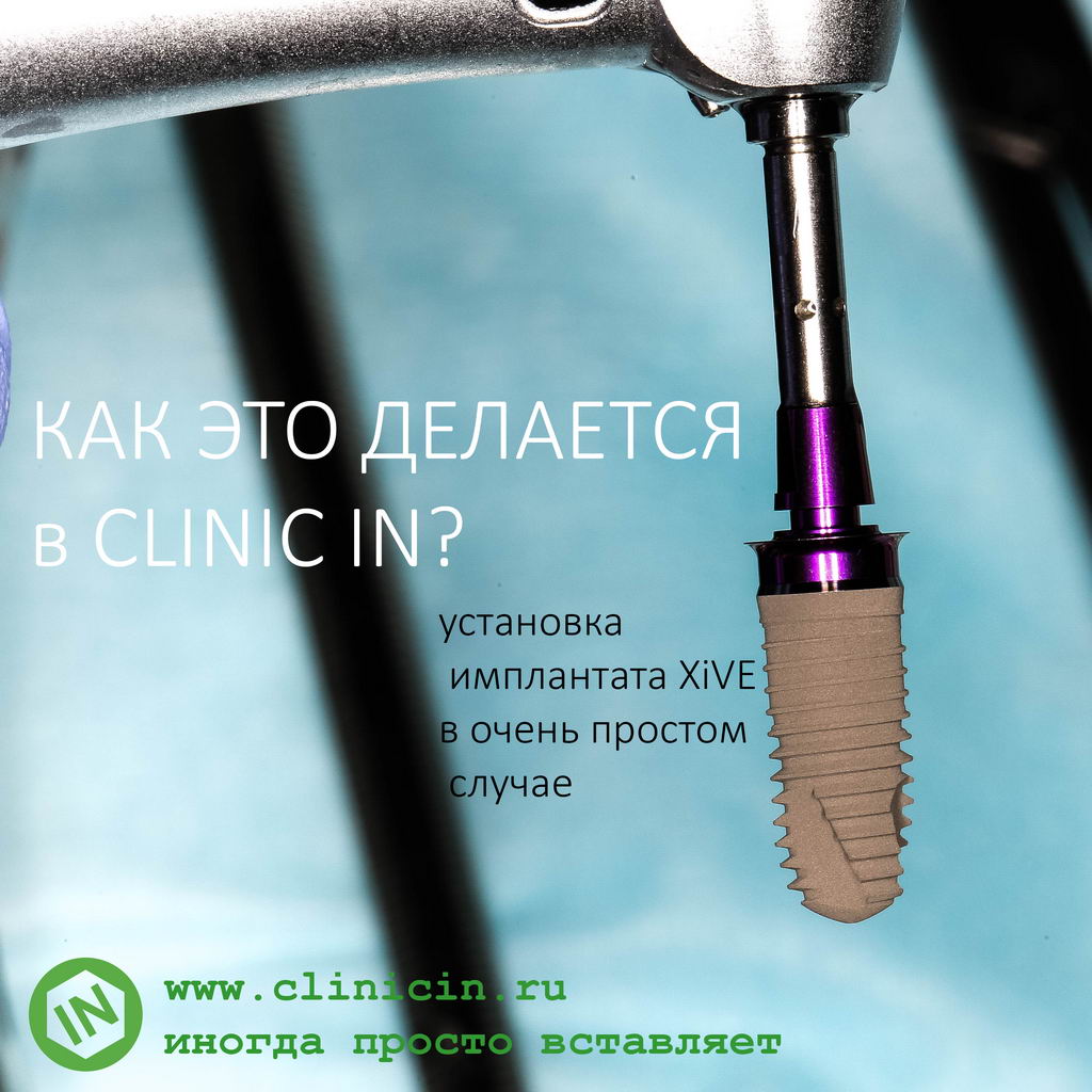 Установка имплантата XiVE в CLINIC IN. Как это делается?