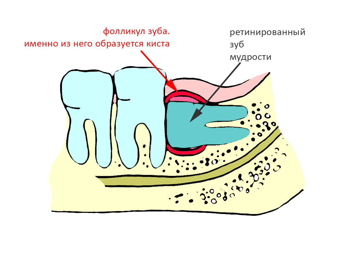 Зуб мудрости смешные картинки