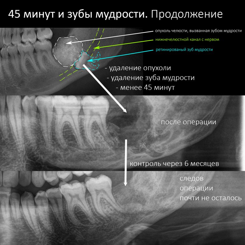 Зуб отдает в другой зуб: найдено 90 изображений