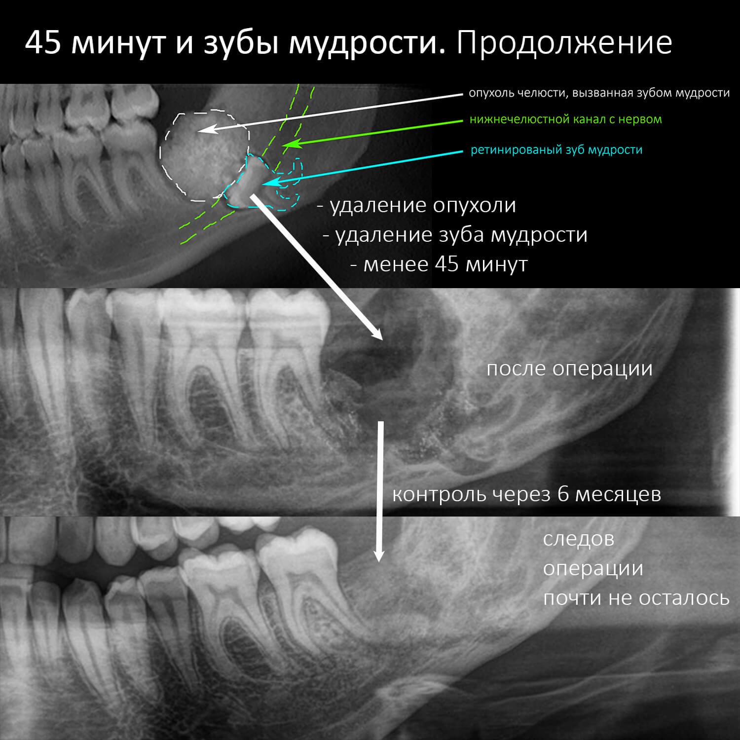 Шеф сказал: про 45 минут и зубы мудрости. Продолжение. — CLINICIN.RU