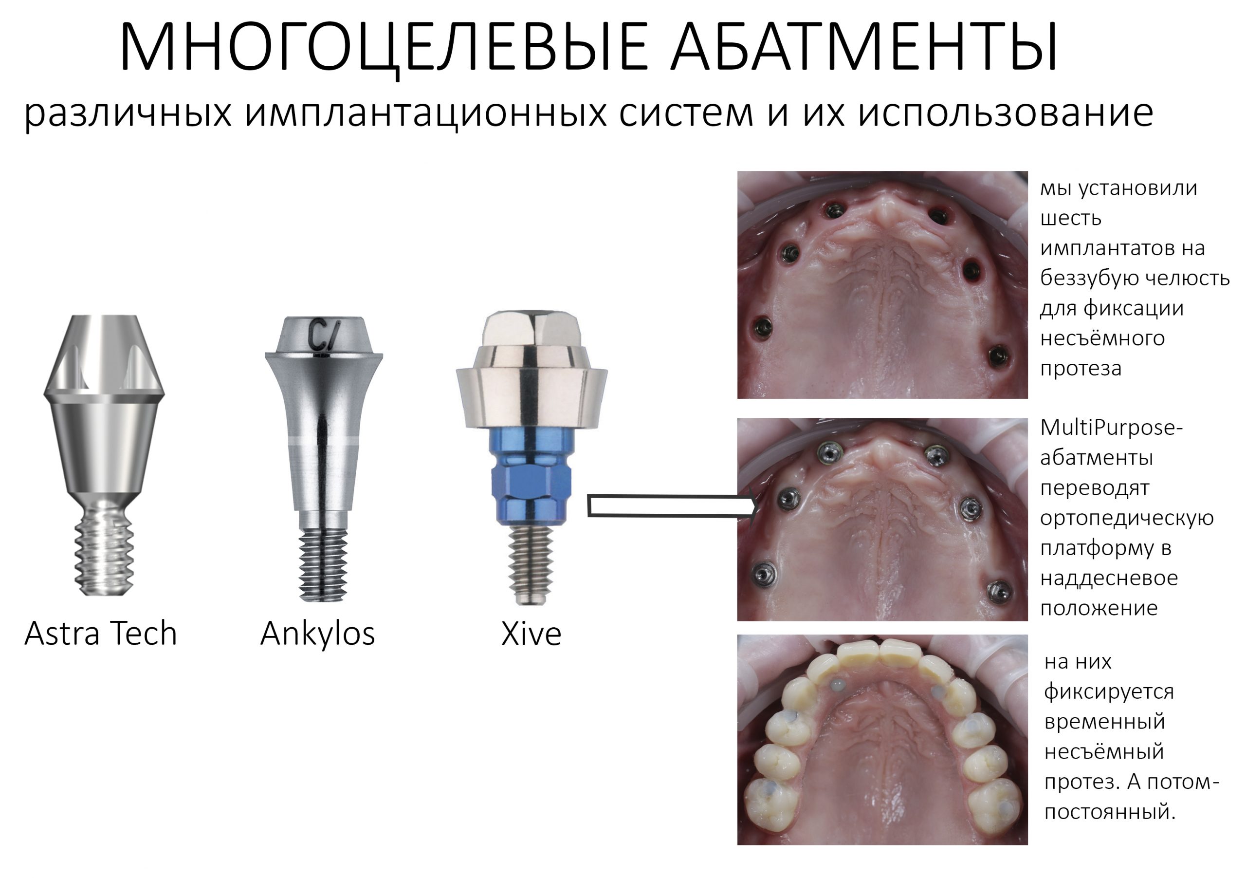 Этапы имплантации зуба пошаговое описание и фото