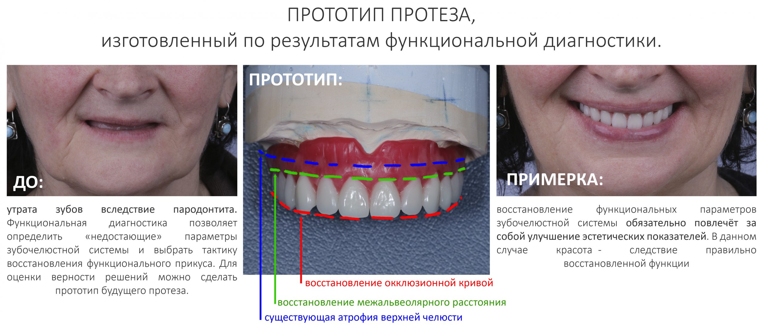 Какие зубные протезы лучше при отсутствии зубов. Несъемные протезы при полном отсутствии зубов. Несъёмные зубные протезы при полном отсутствии зубов. Несъёмные зубные протезы при полном отсутствии. Протезирование на имплантах при полном отсутствии зубов.