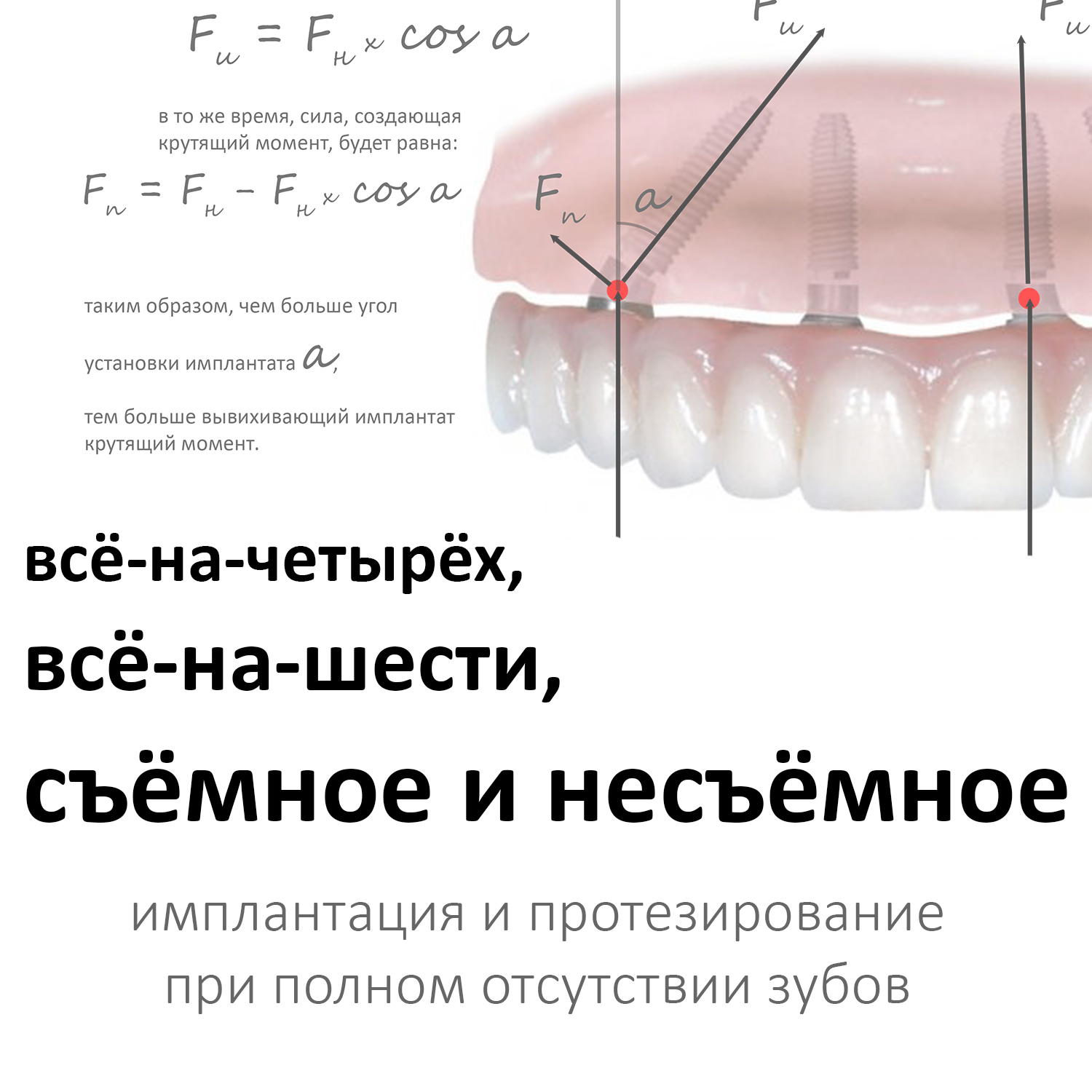 «На четырёх»,»на шести», съёмное и несъёмное — имплантация и протезирование при полном отсутствии зубов