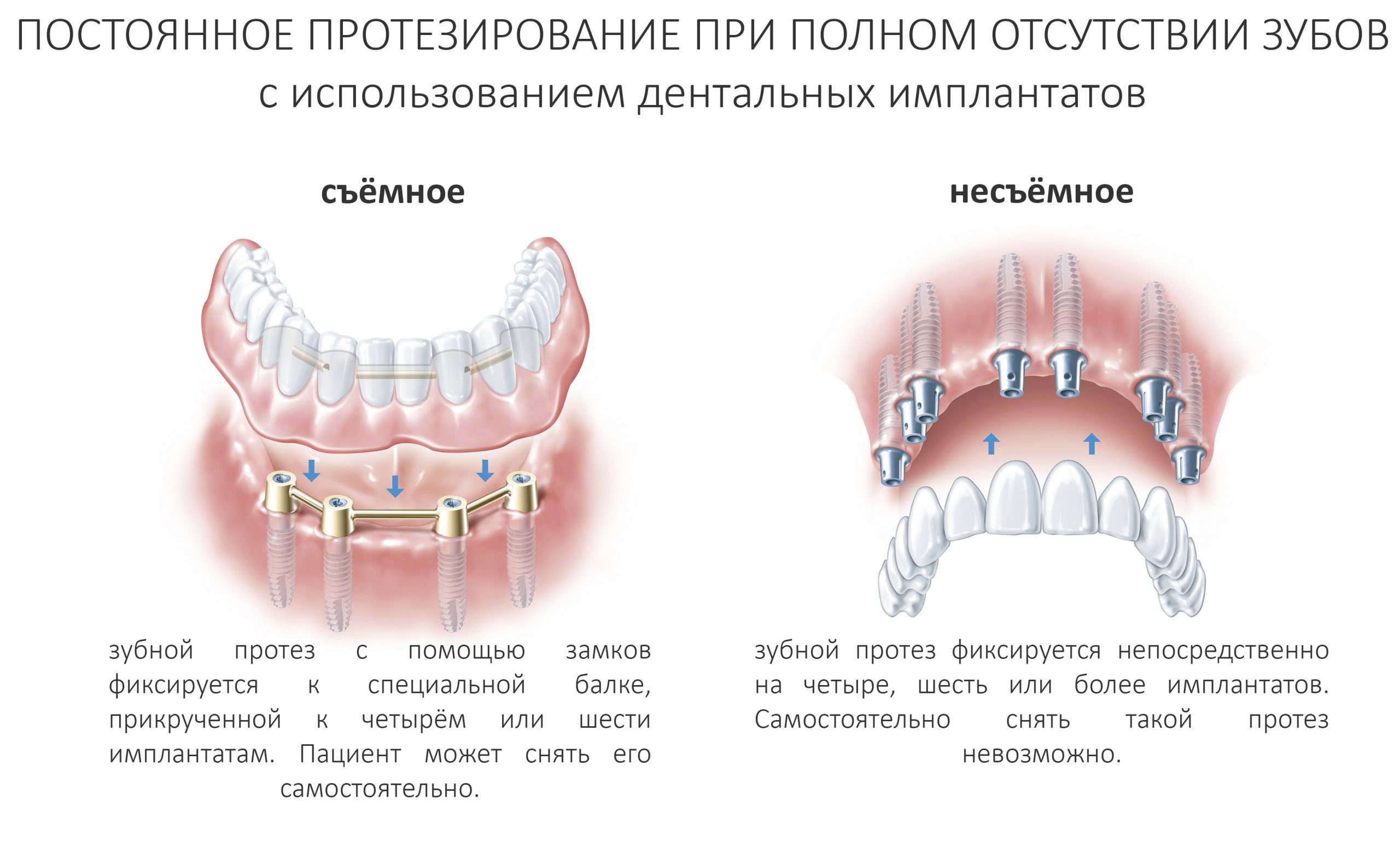 Какие зубные протезы лучше при отсутствии зубов. Схема установки съёмного протеза на импланты. Балочная вид фиксации протеза несъемного. Съемный протез с балочной системой фиксации схема. Съемный частичный протез при частичном отсутствии зубов.