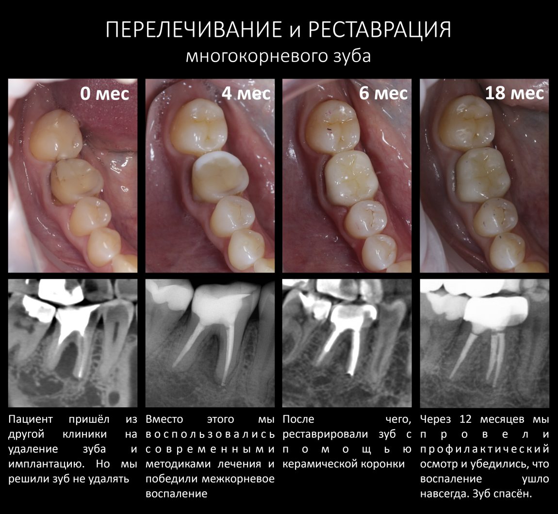 Реконструкция зубов фото