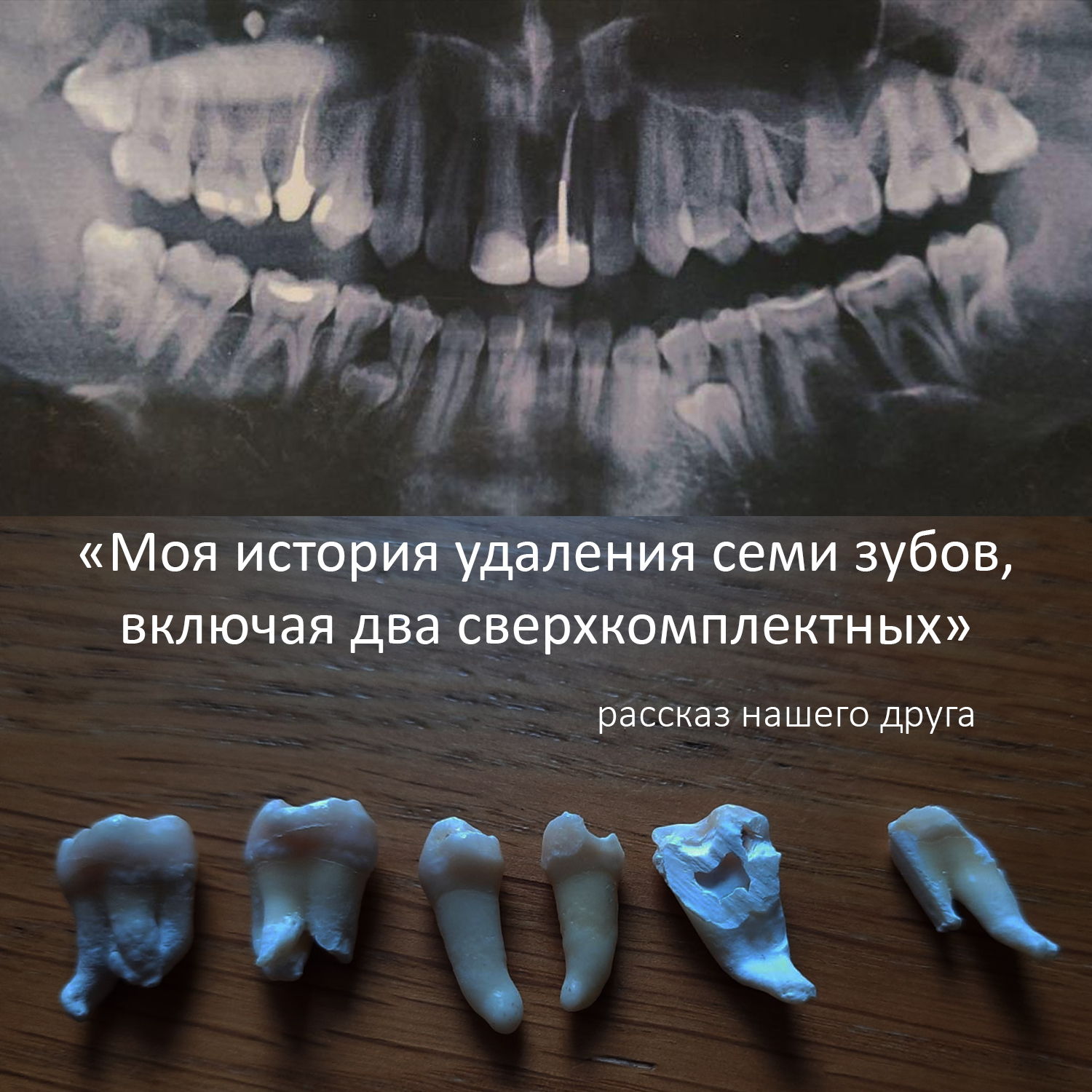 «Моя история удаления семи зубов, включая два сверхкомплектных». Рассказ нашего друга