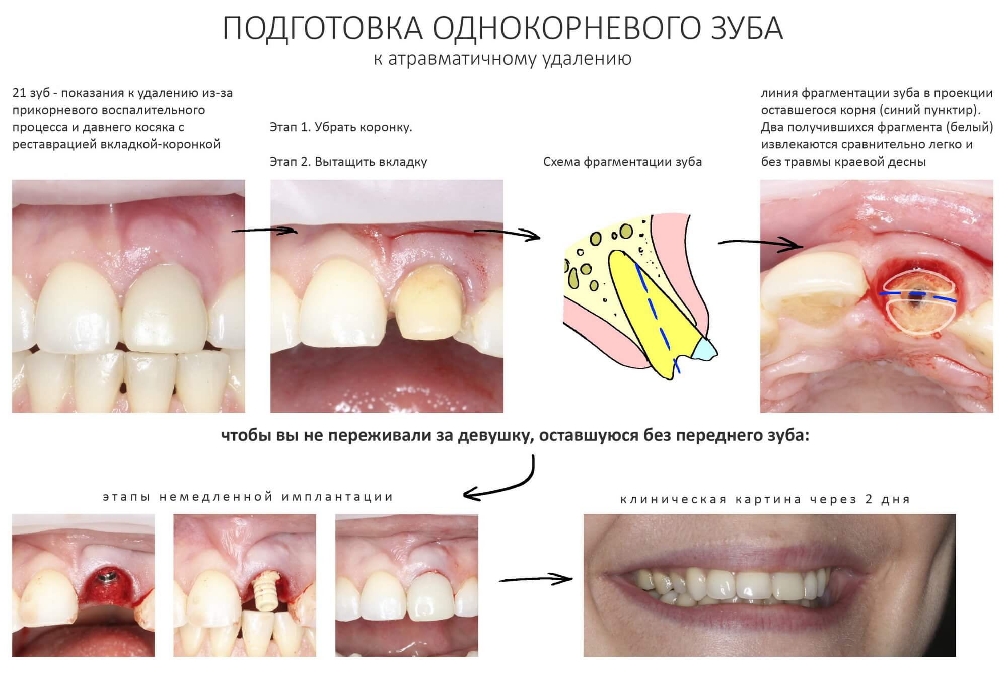 Вопросы по удалению зубов
