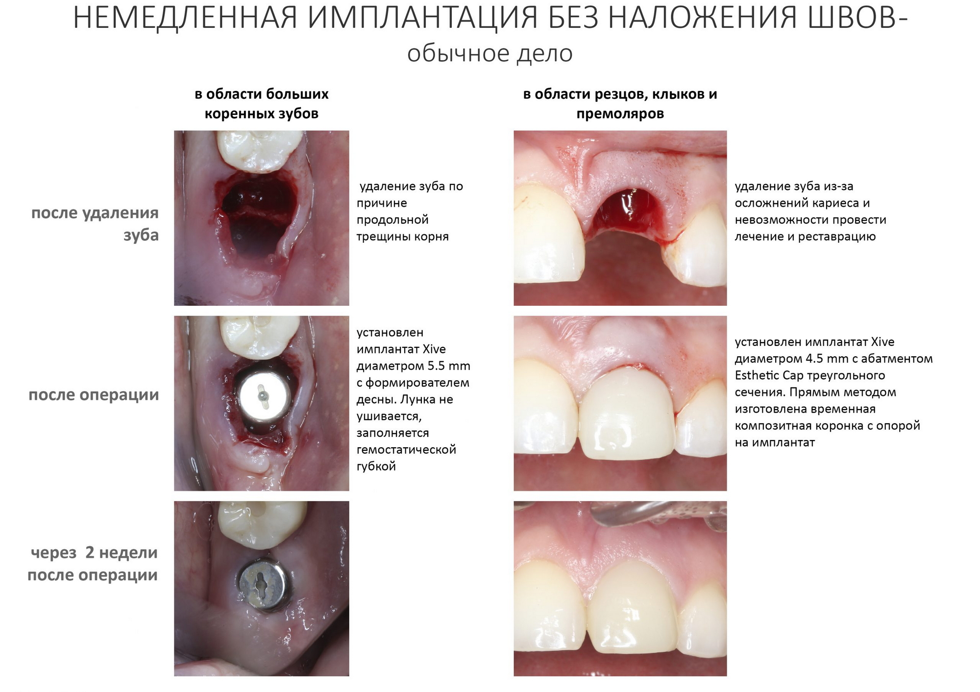 Что делать после удаления зуба - Стоматологическая клиника доктора Лапченко - Блог
