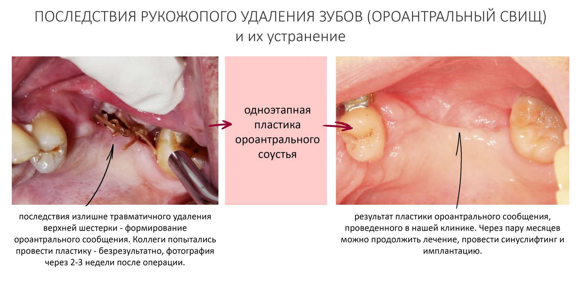 можно ли делать минет после удаления зуба фото 51