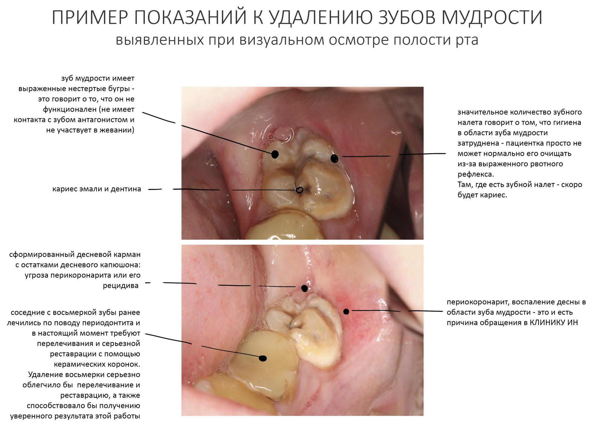 Что делать при появлении дырки в зубе?