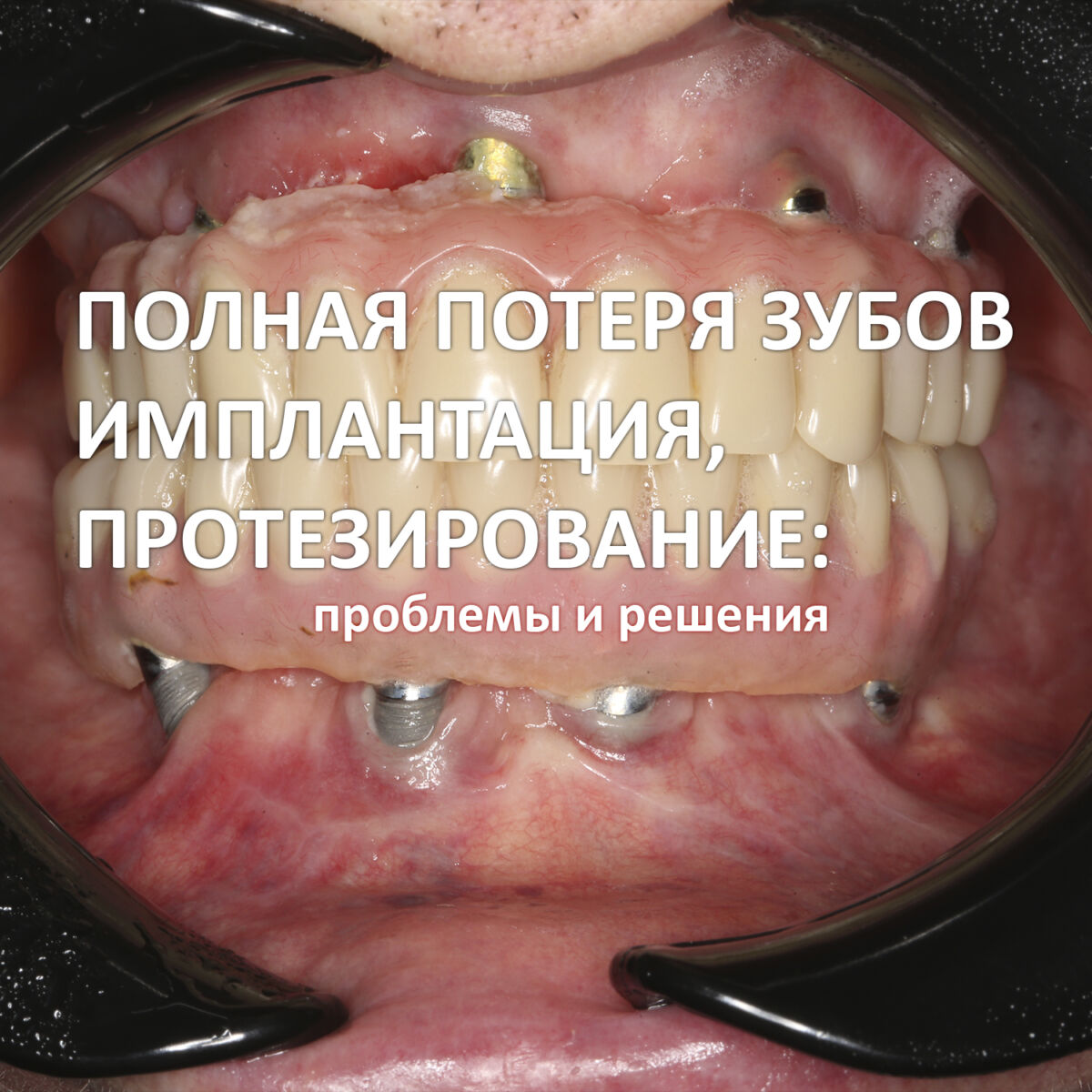 Полная потеря зубов, имплантация, протезирование: проблемы и решения.