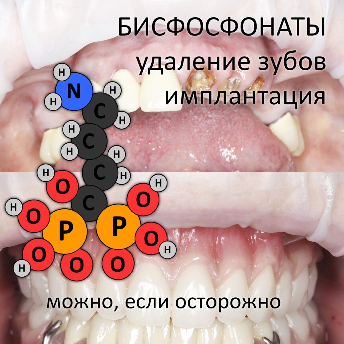 БИСФОСФОНАТЫ, УДАЛЕНИЕ ЗУБОВ, ИМПЛАНТАЦИЯ: можно, если осторожно.