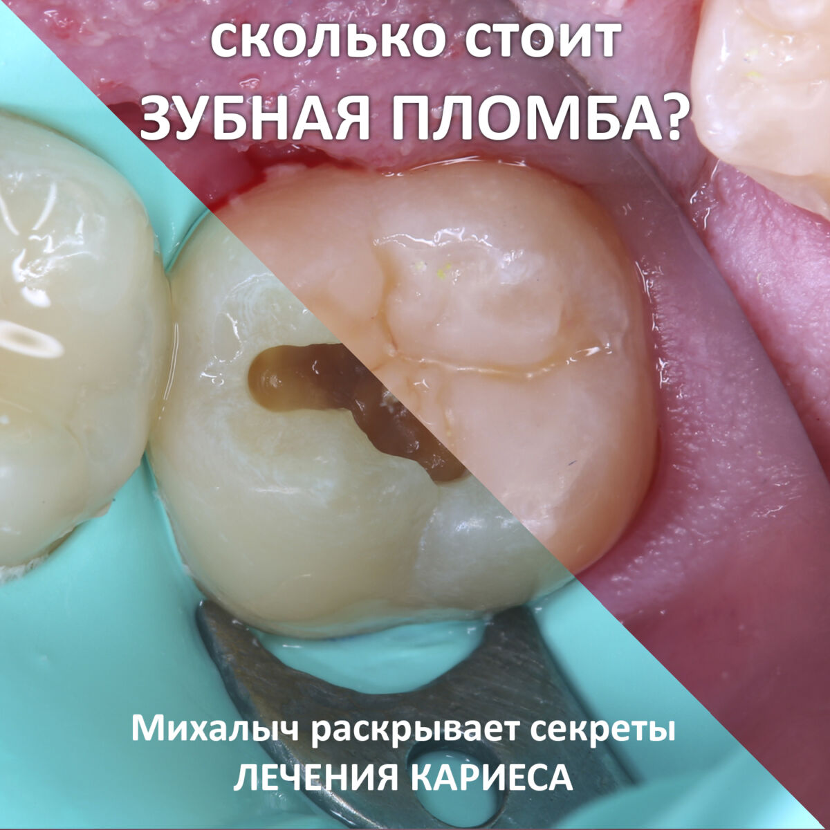 Сколько стоит зубная пломба? Михалыч раскрывает тайны лечения кариеса