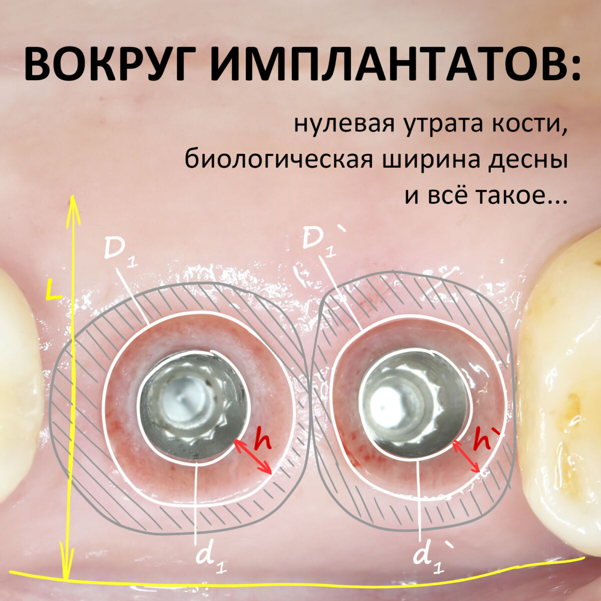 ВОКРУГ ИМПЛАНТАТОВ: нулевая утрата кости, биологическая ширина десны и всё такое