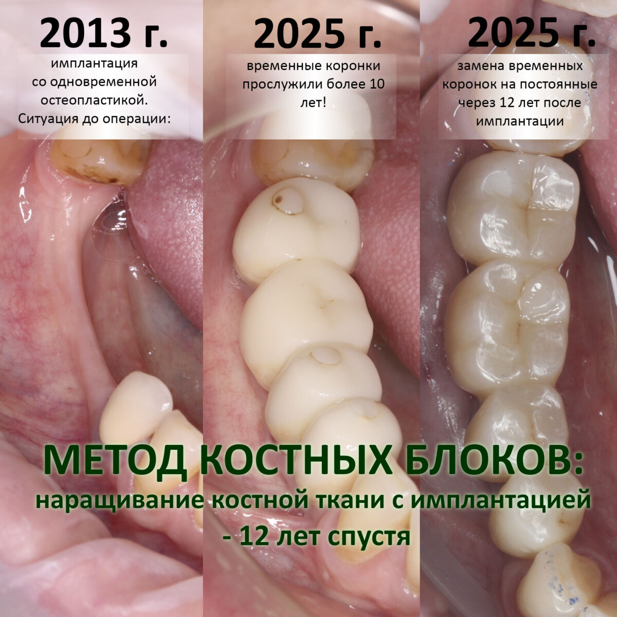 МЕТОД КОСТНЫХ БЛОКОВ: наращивание костной ткани с имплантацией — 12 лет спустя.