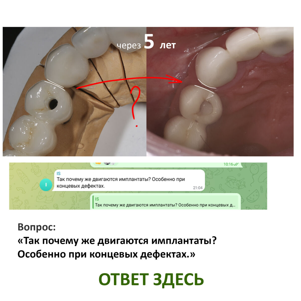 Спрашивали: «Так почему же двигаются имплантаты? Особенно при концевых дефектах.» ОТВЕЧАЕМ: