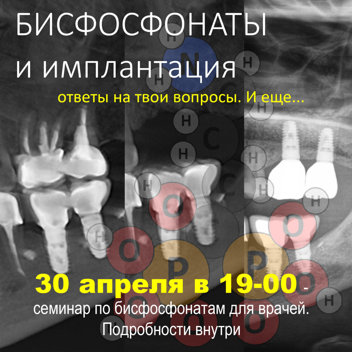 БИСФОСФОНАТЫ и ИМПЛАНТАЦИЯ: ответы на твои вопросы.