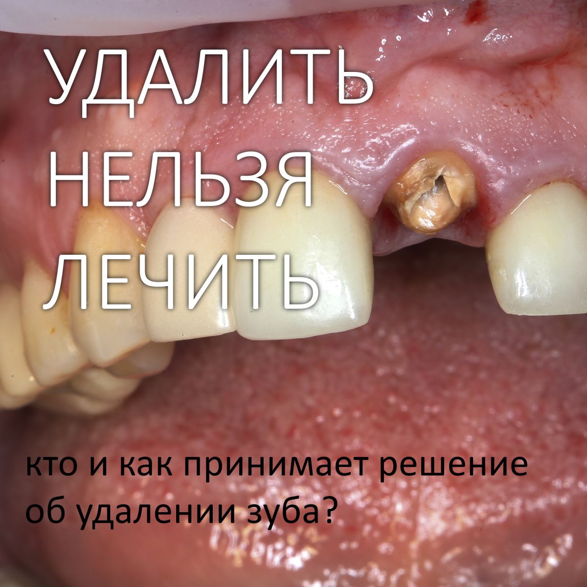 «Удалить нельзя лечить» — кто и как принимает решение об удалении зуба?